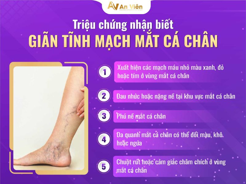 giãn tĩnh mạch mắt cá chân