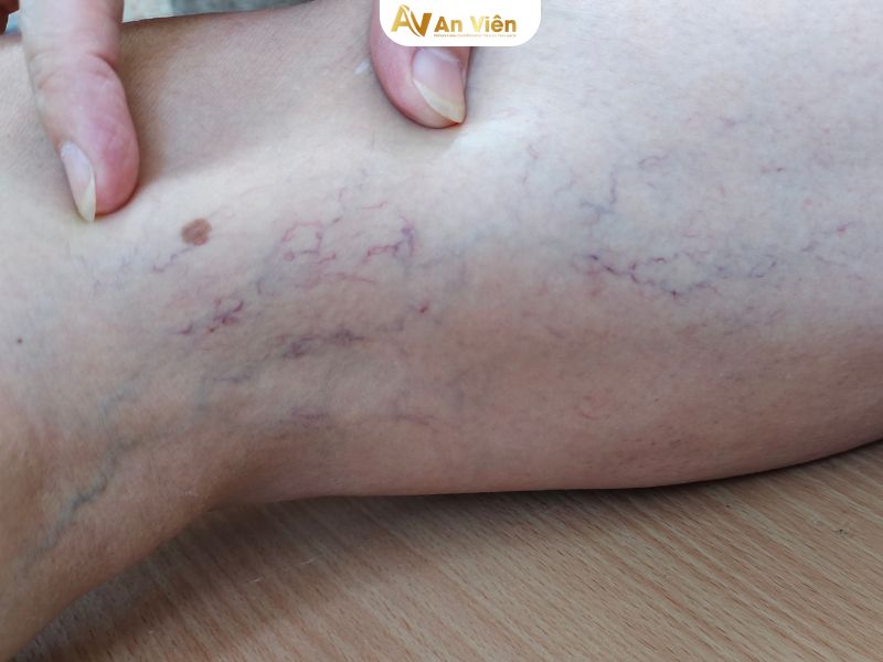 hoa hòe chữa suy giãn tĩnh mạch
