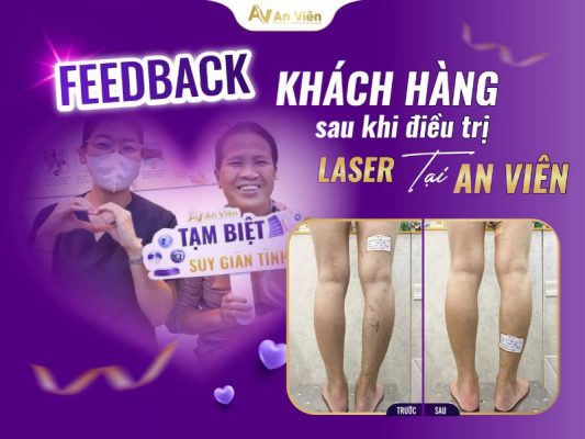 khám giãn tĩnh mạch chân ở đâu