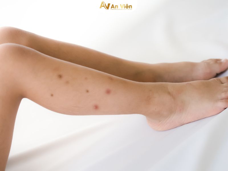 suy giãn tĩnh mạch chân ở trẻ em