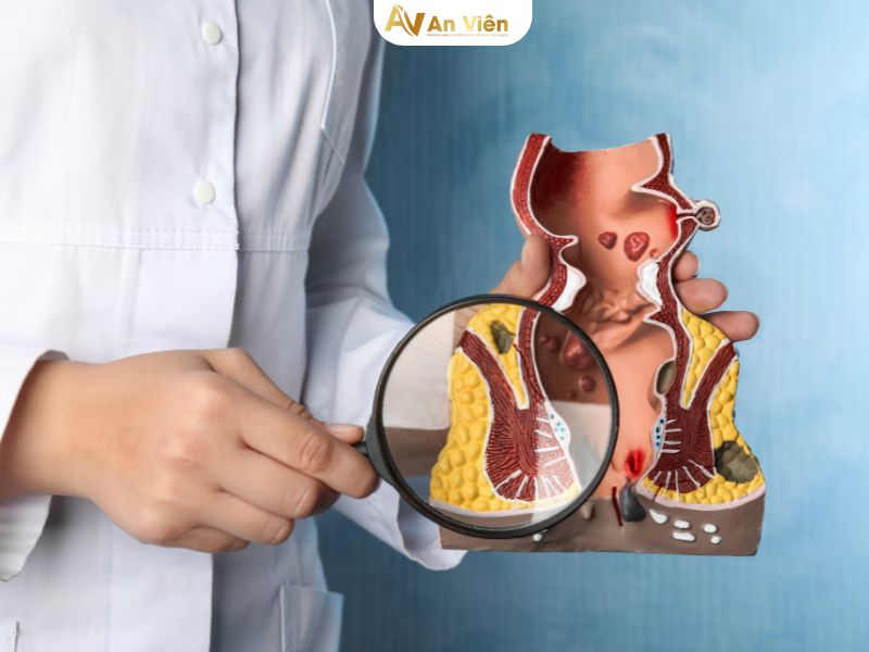 suy giãn tĩnh mạch hậu môn