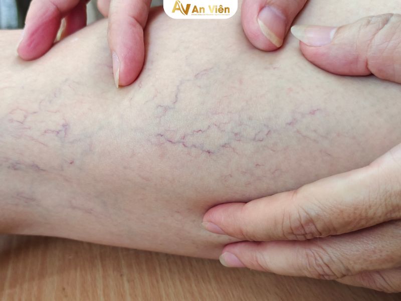 suy giãn tĩnh mạch nông và sâu