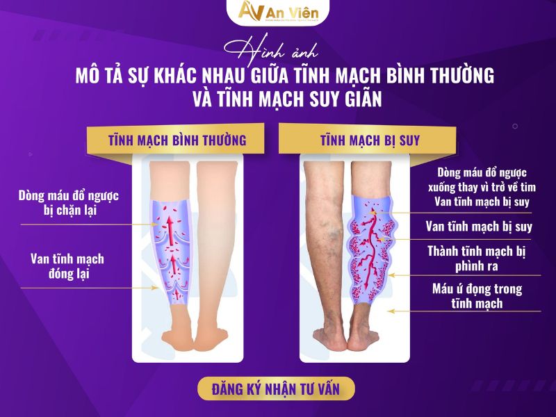 suy giãn tĩnh mạch nông và sâu