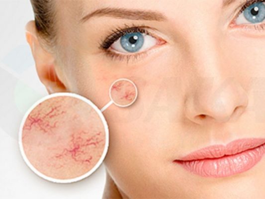 suy giãn tĩnh mạch ở mặt