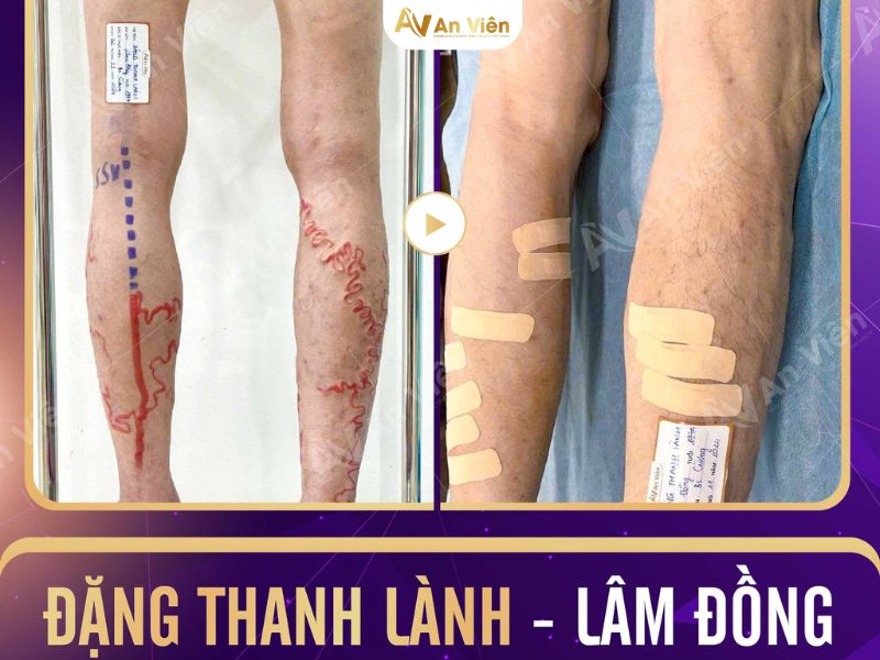 tĩnh mạch an viên